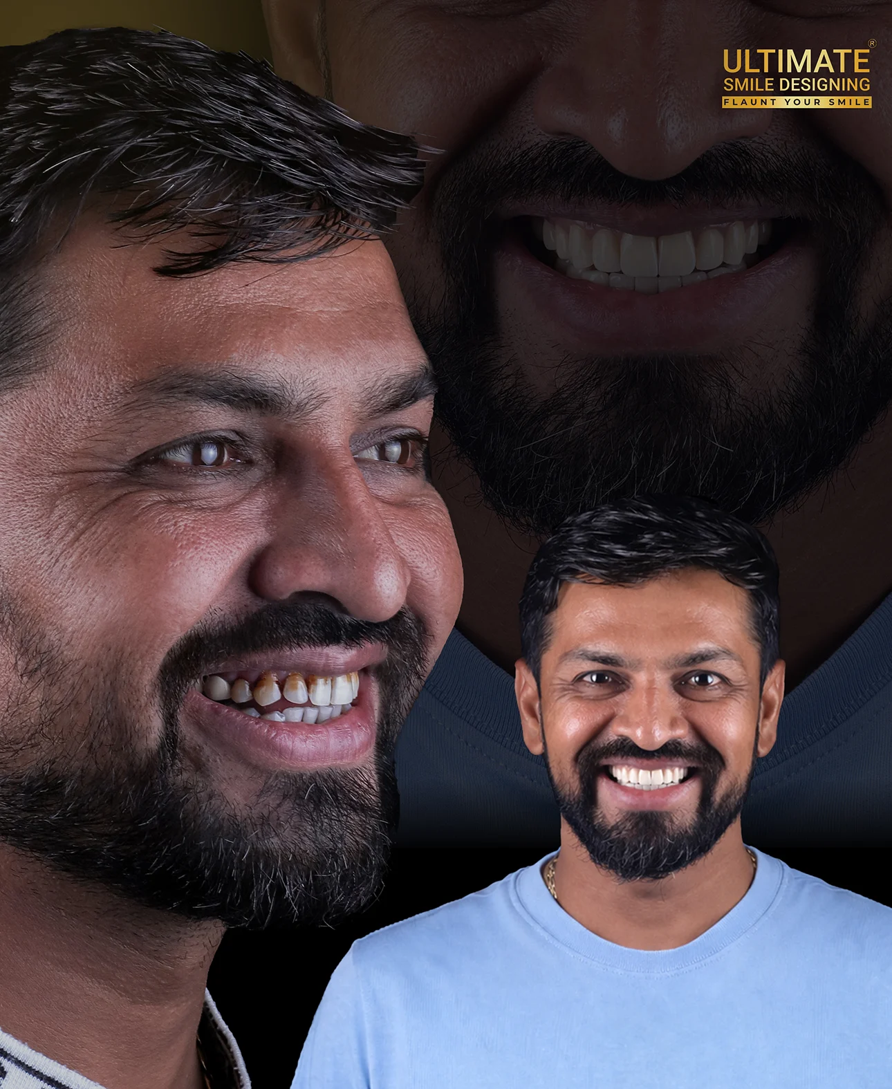 Ultimate Smile Design Before After Image Showcasing Best Smile Design Result