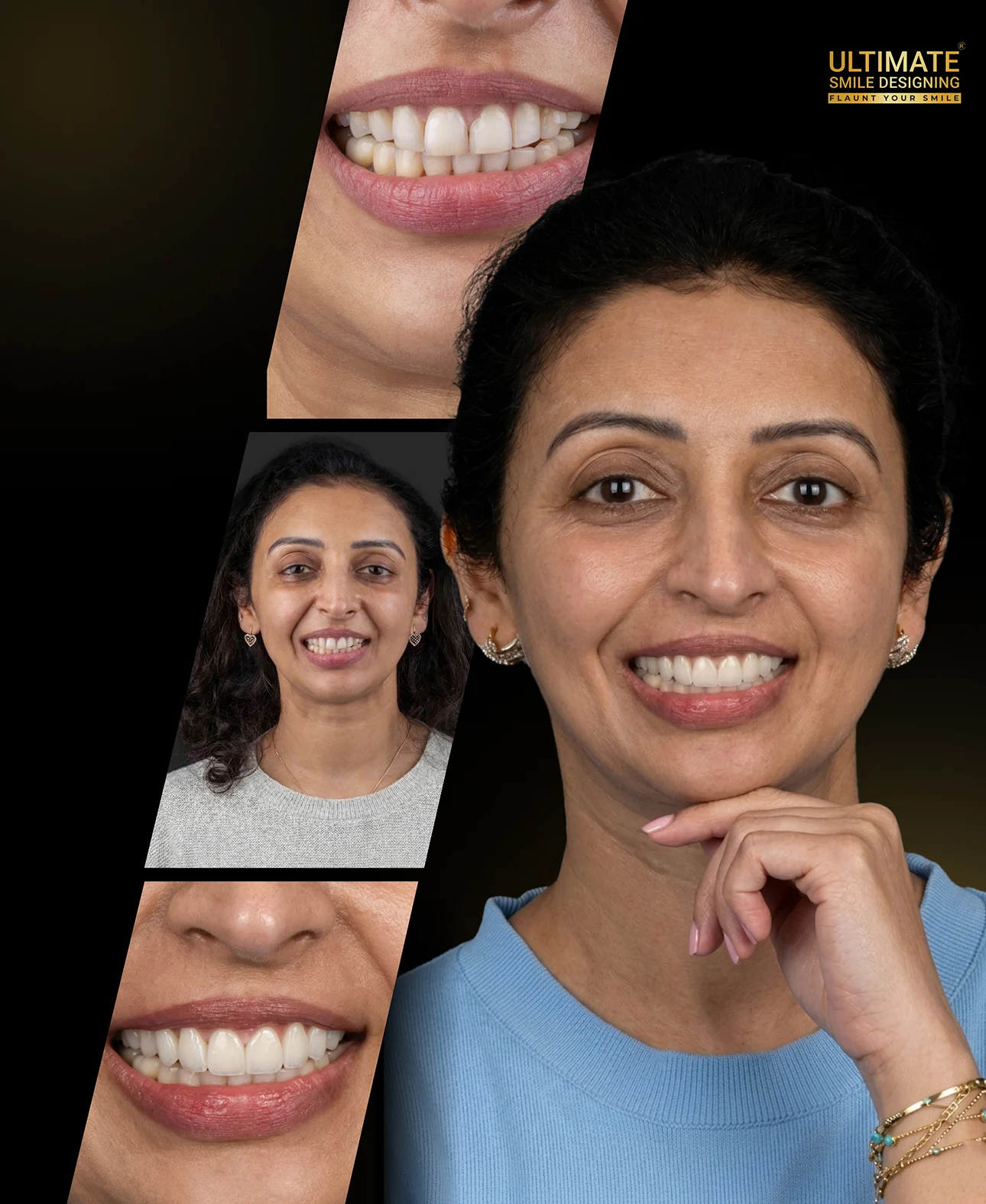 Smile design before after Image - Patient smile transformation