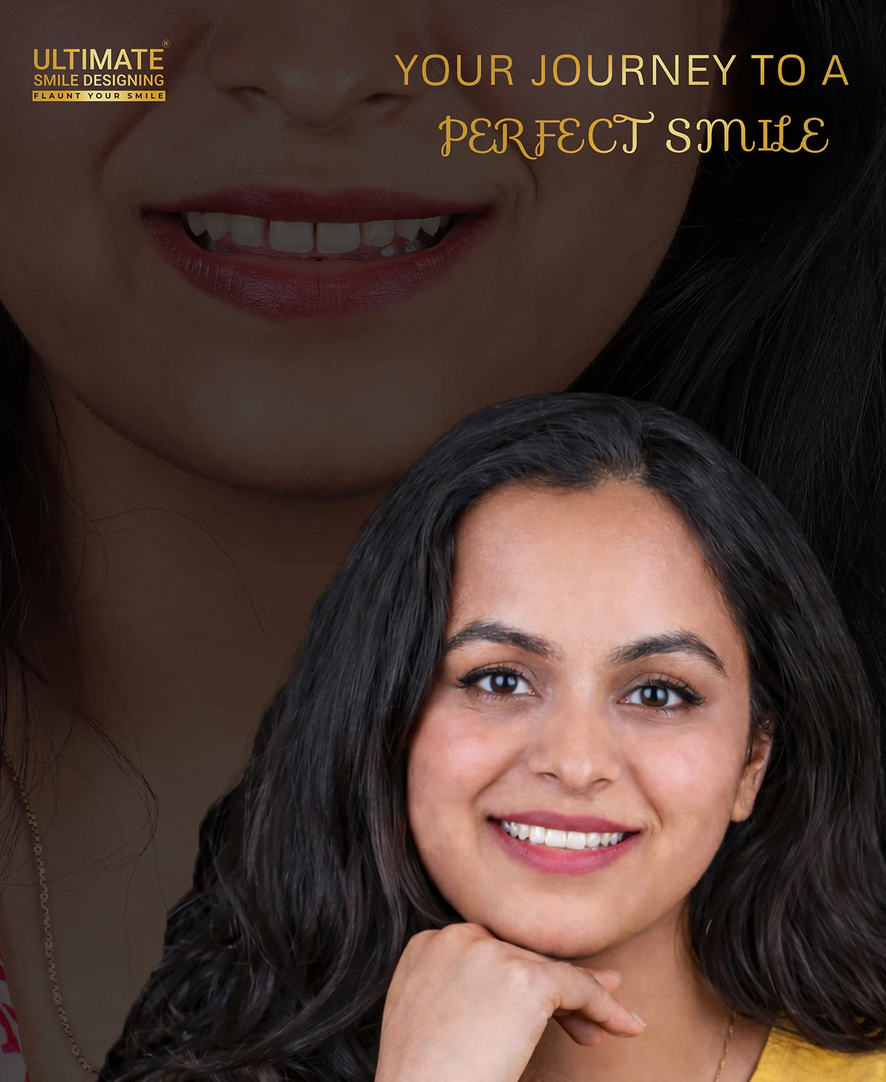 Smile design before and after results – improved tooth alignment
