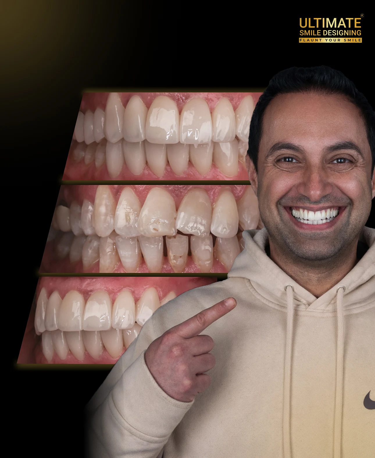 Full mouth rehabilitation results – aesthetic smile improvement