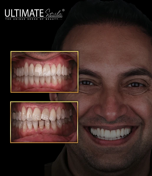 Full mouth rehabilitation results – aesthetic smile improvement