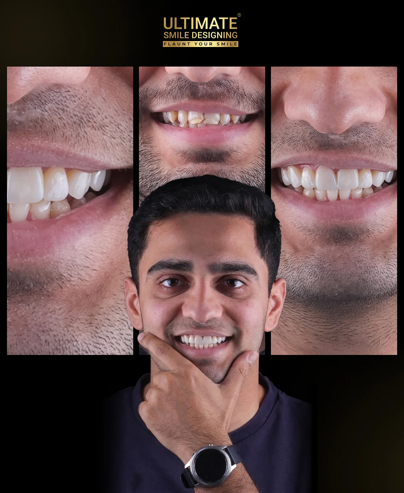 Dental veneers treatment before and after – enhanced smile aesthetics