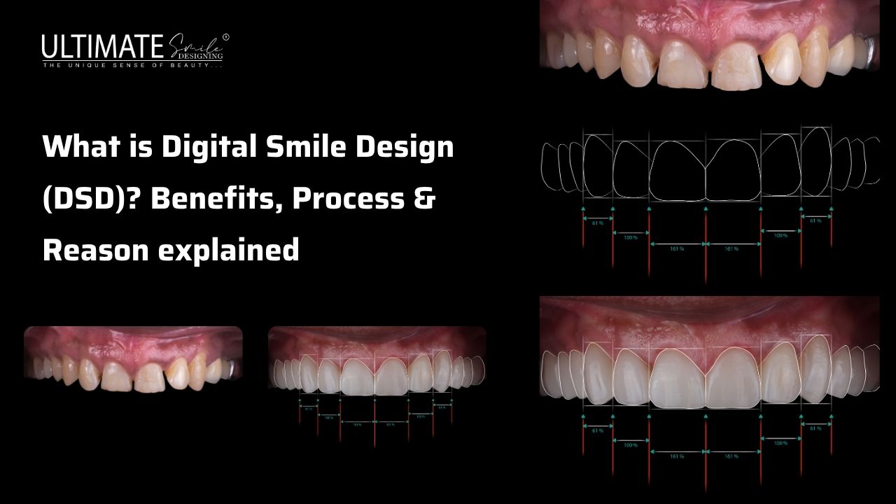 What is Digital Smile Design (DSD)? Benefits, Process & Reason explained