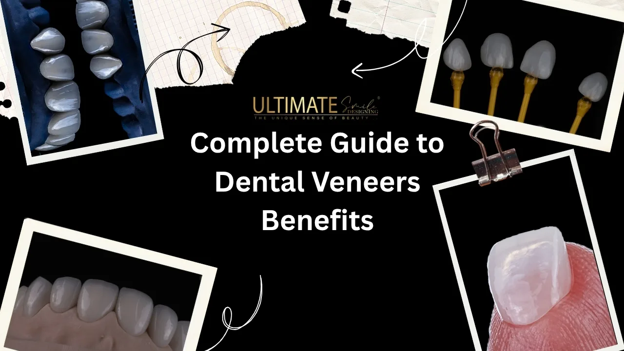 Dental Veneer Benefits: How Veneers Transform Smiles