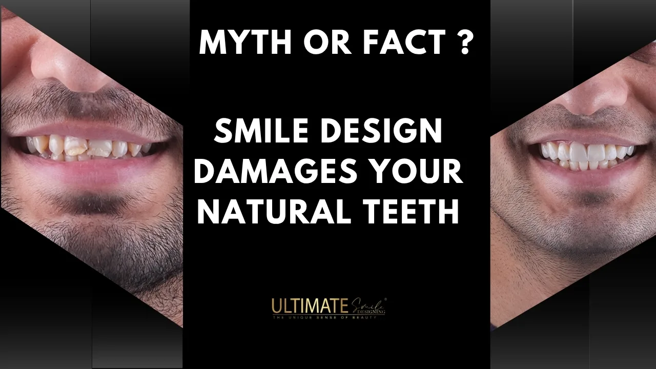Cosmetic-Dentistry-Damages-Your-Natural-Teeth