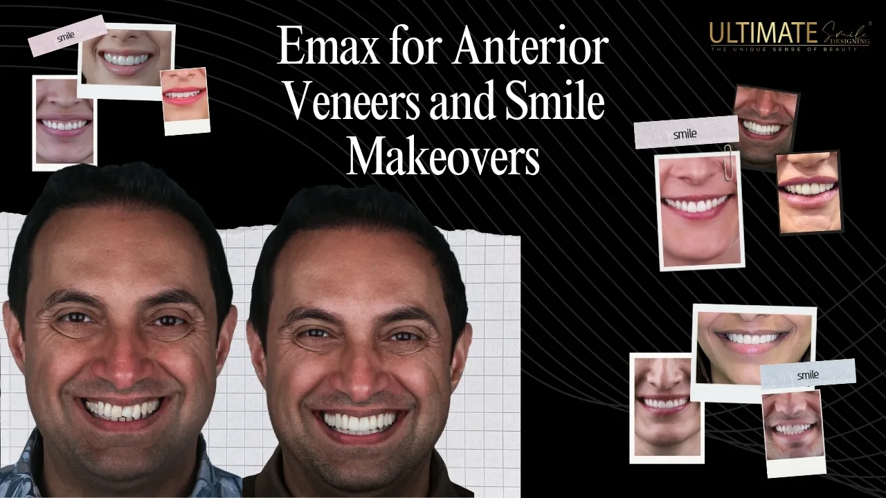 Complete Guide to Emax Veneers for Anterior Teeth 2026