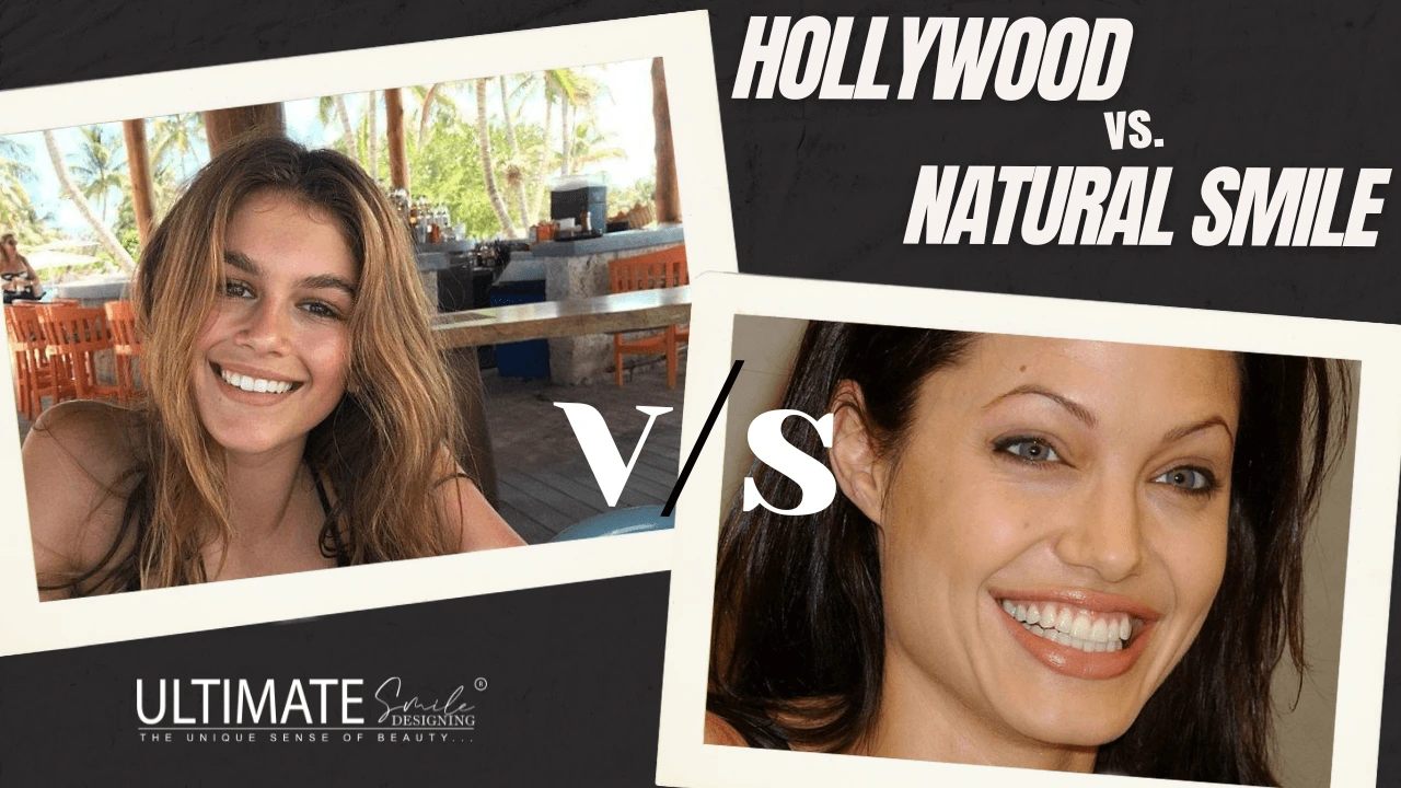 Hollywood vs. Natural Smile Design: Comparison & Key Differences