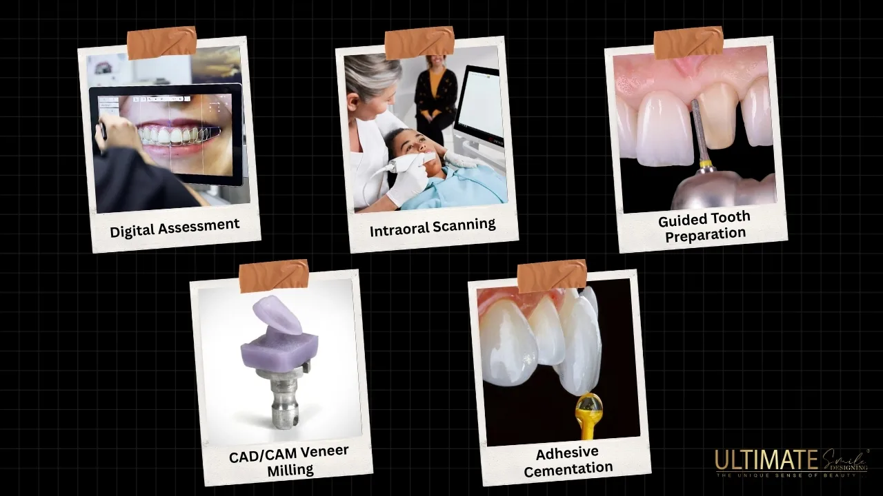 Process-of-Getting-Emax-Anterior-Veneers