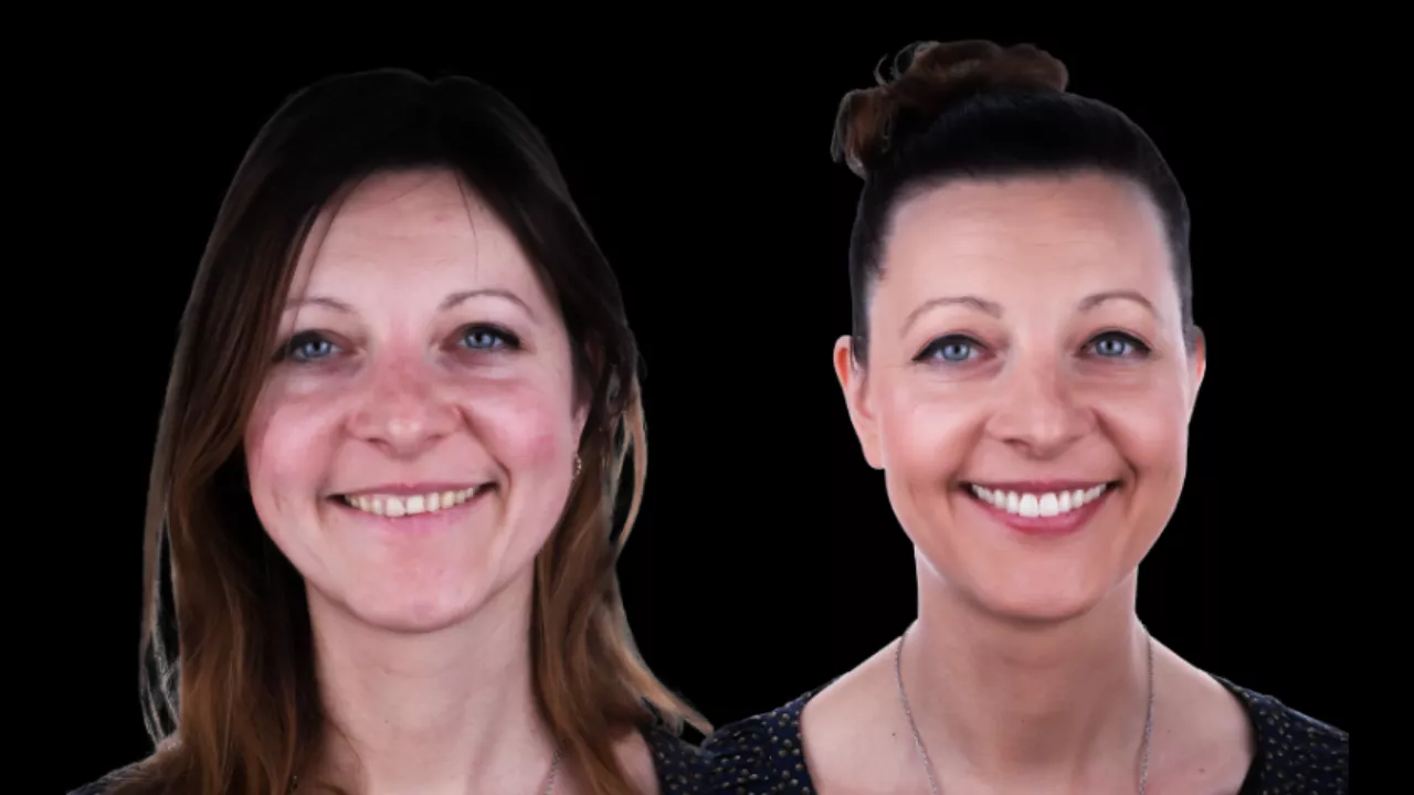 The Psychological Benefits of Smile Designing: More Than Just Aesthetics