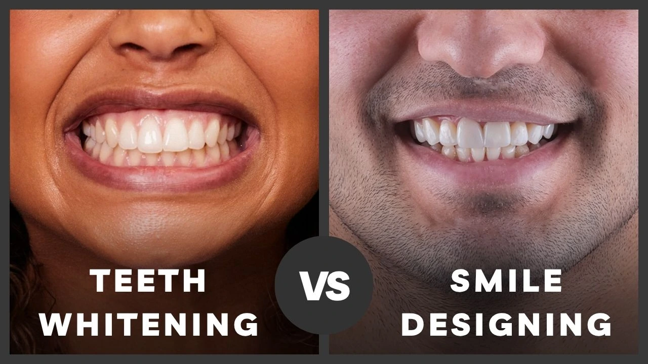 Teeth-Whitening-vs-Smile-Designing-What’s-Right-For-You