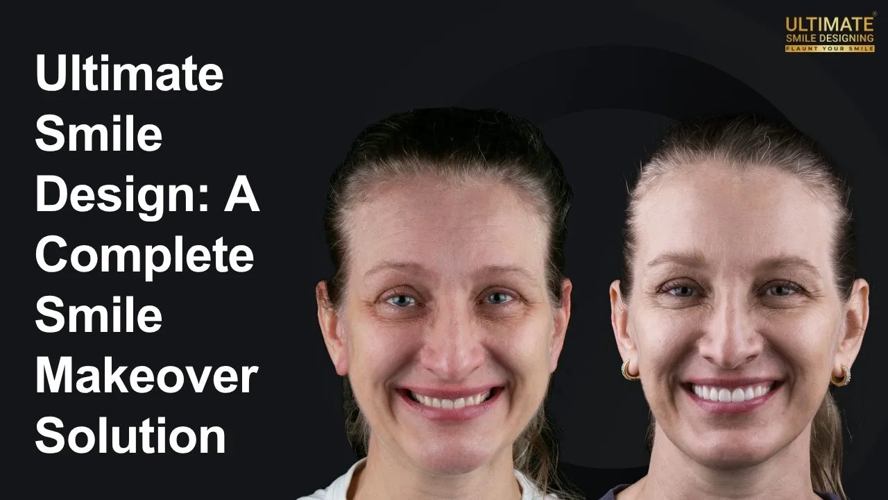 Ultimate-Smile-Design-A-Complete-Smile-Makeover-Solution