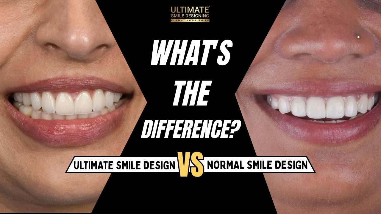 Normal vs Ultimate Smile Design: Key Differences Explained