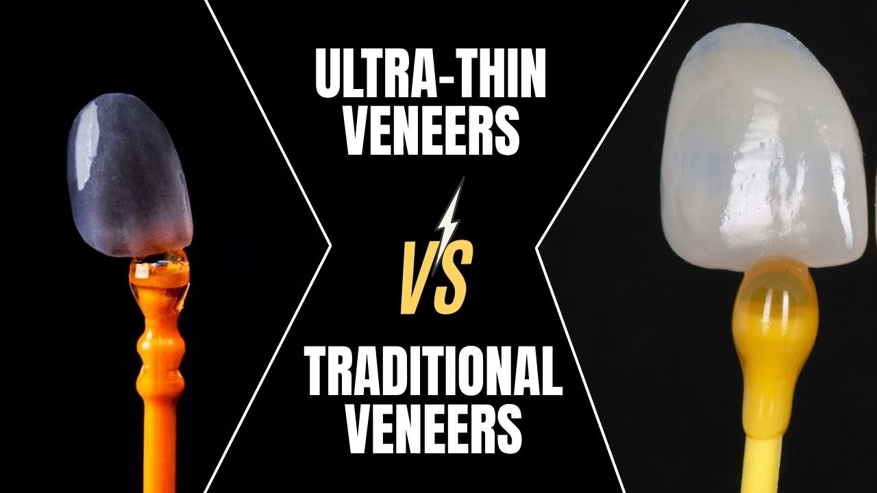 Ultra-Thin-Veneers-Vs-Traditional-Veneers