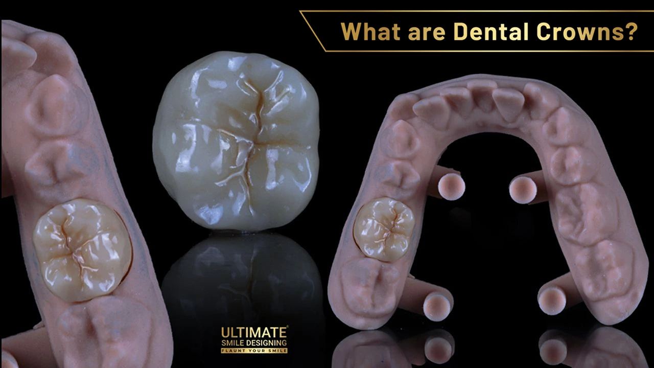 What-are-Dental-Veneers