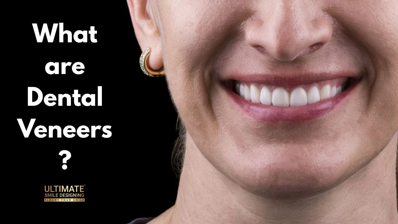 What-are-Dental-Veneers-new