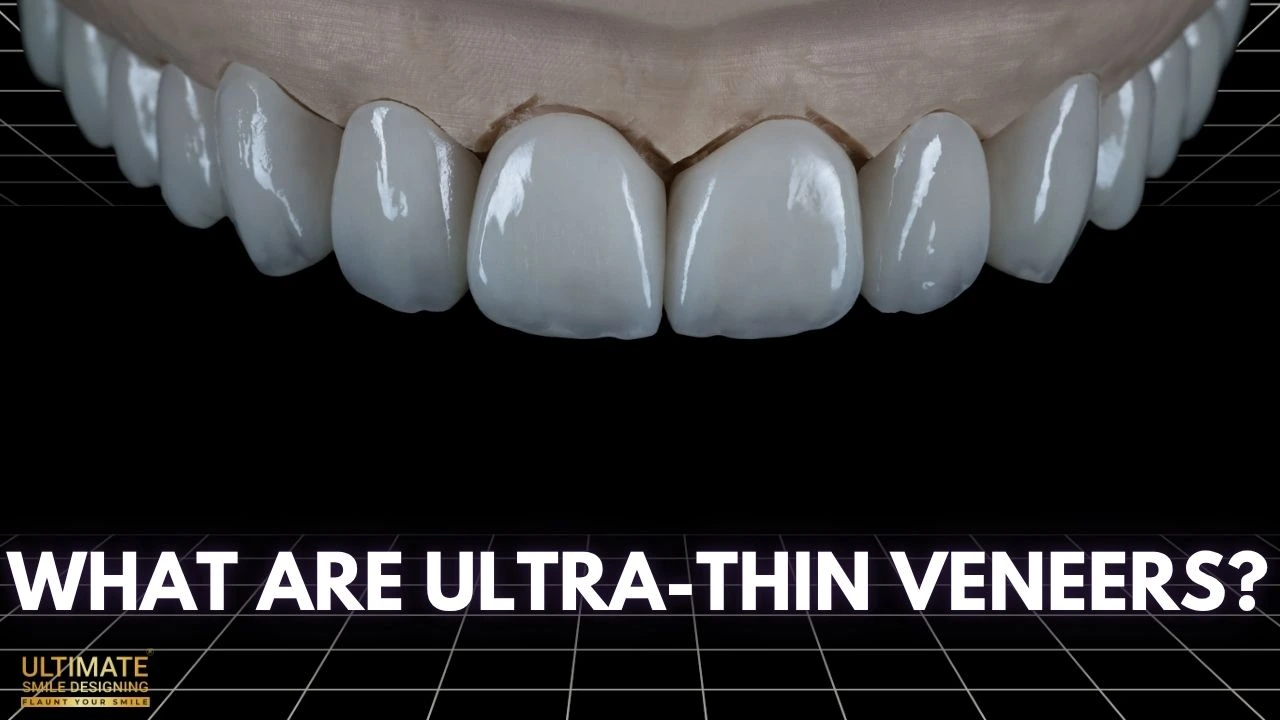 What-are-Ultra-Thin-Veneers