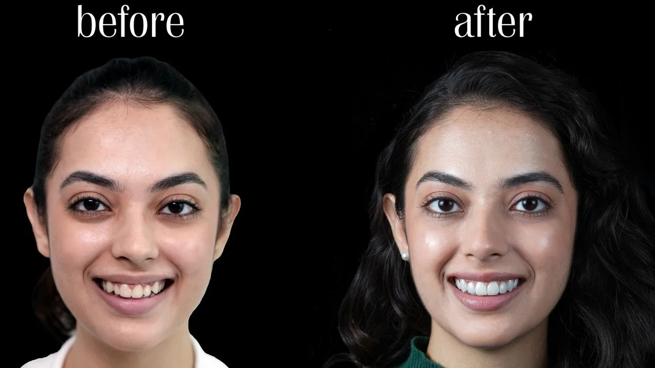 What-is-Smile-Correction