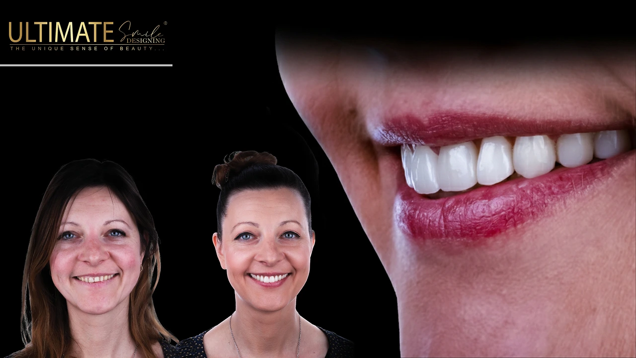 What-is-a-Hollywood-Smile