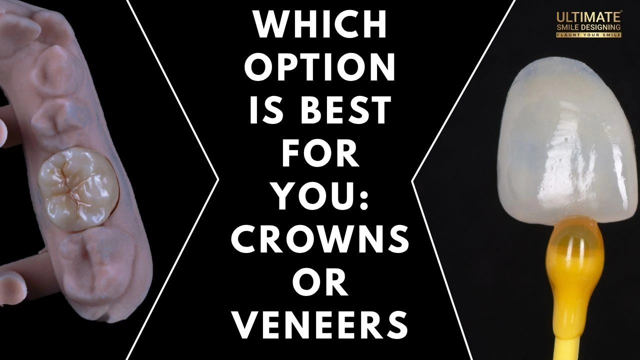 Which-Option-is-Best-for-You-Crowns-or-Veneers