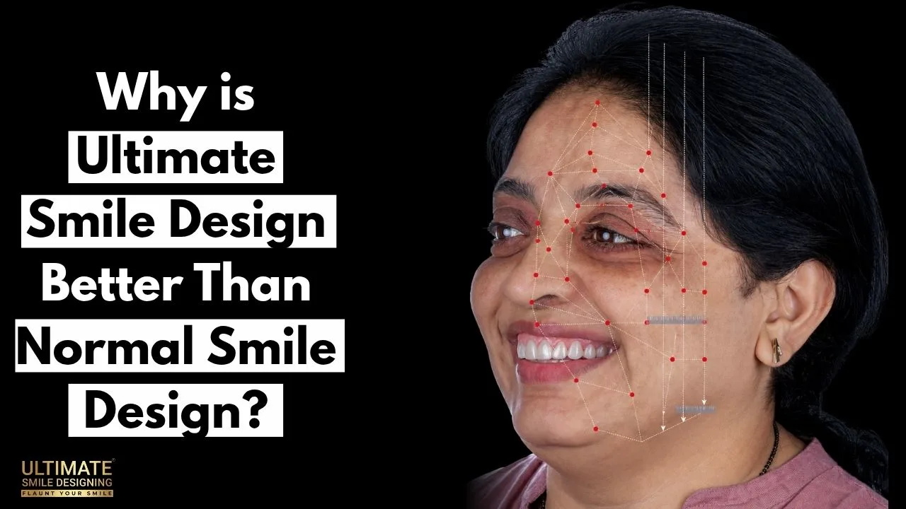 Why-is-Ultimate-Smile-Design-Better-Than-Normal-Smile-Design