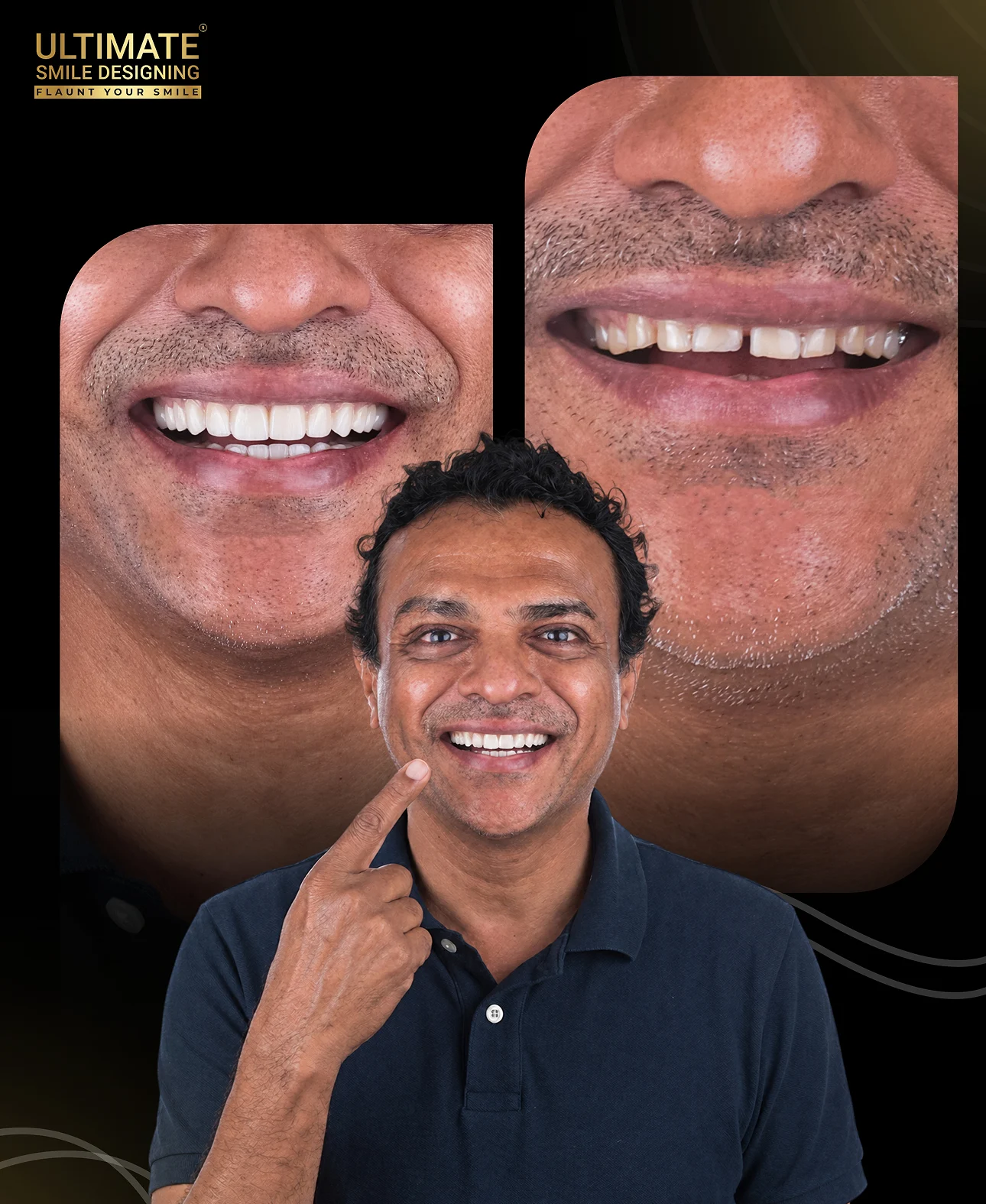 Cosmetic dentistry before and after results showing an Ultimate Smile Design transformation