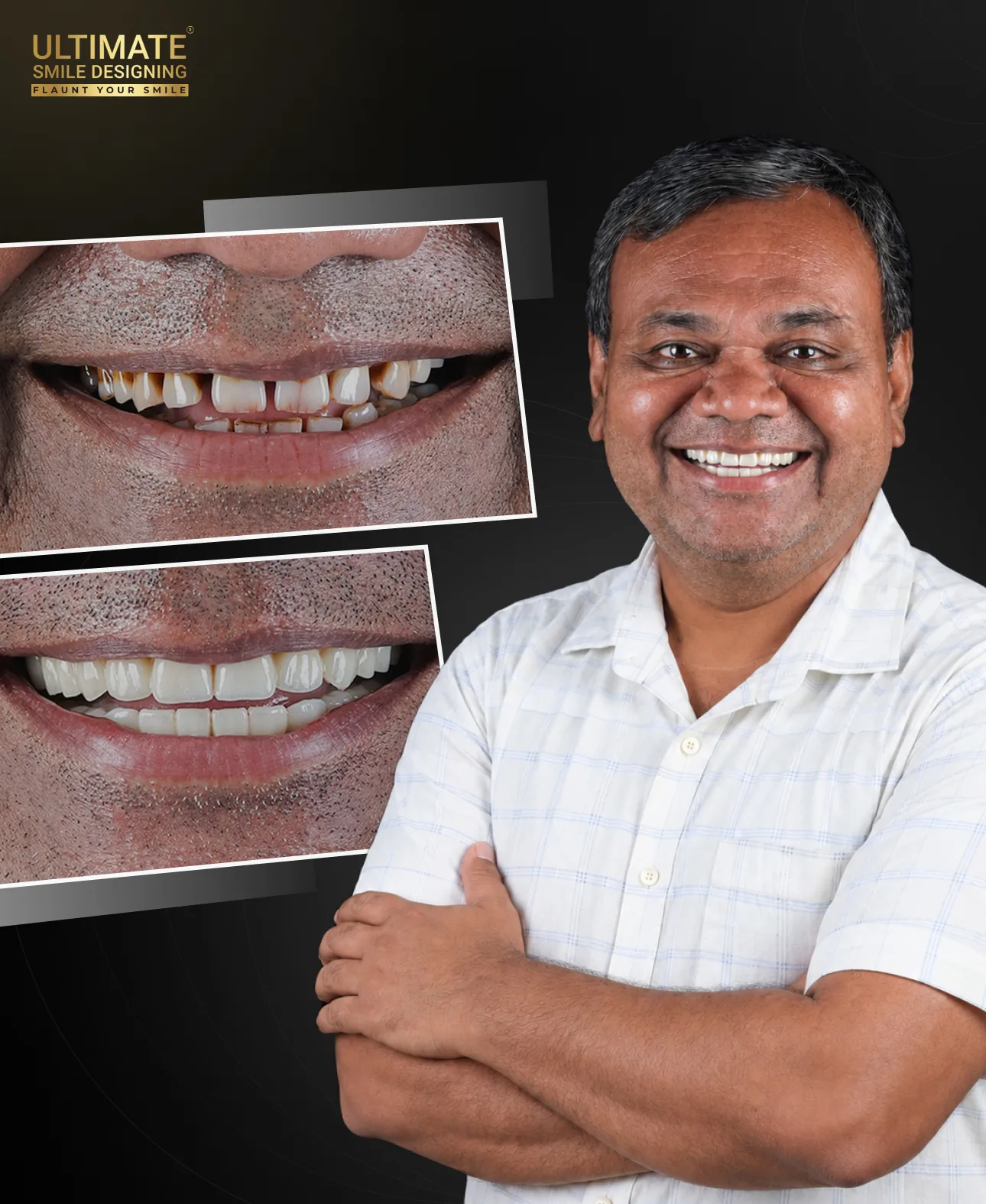 Successful Ultimate Smile Design before and after transformation by certified smile designer dentist