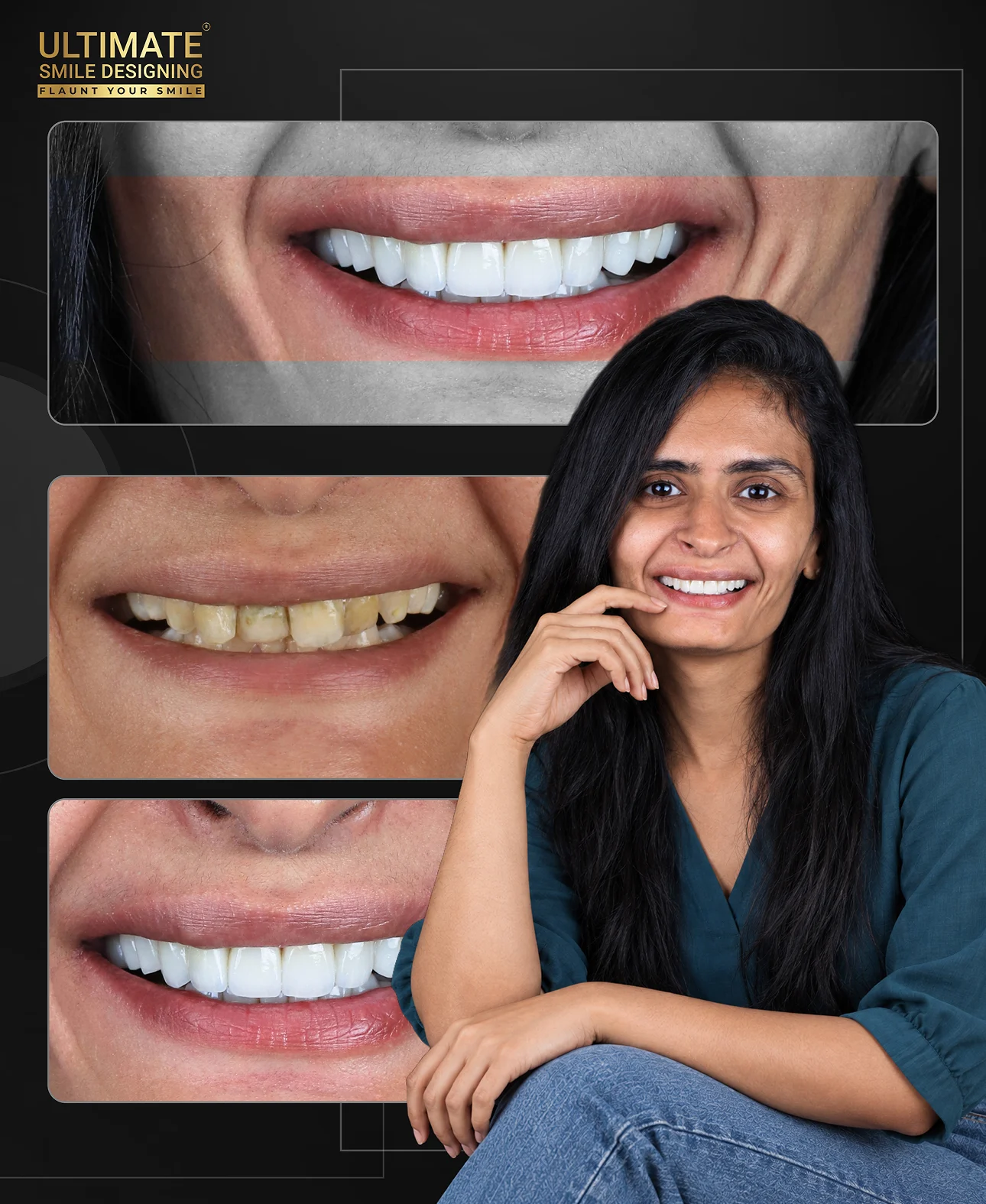 Before and after Ultimate Smile SDsign treatment of a real patient