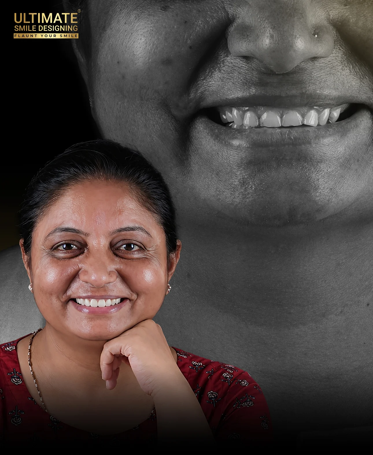 Real patient smile makeover before and after preview created by Ultimate Smile Design