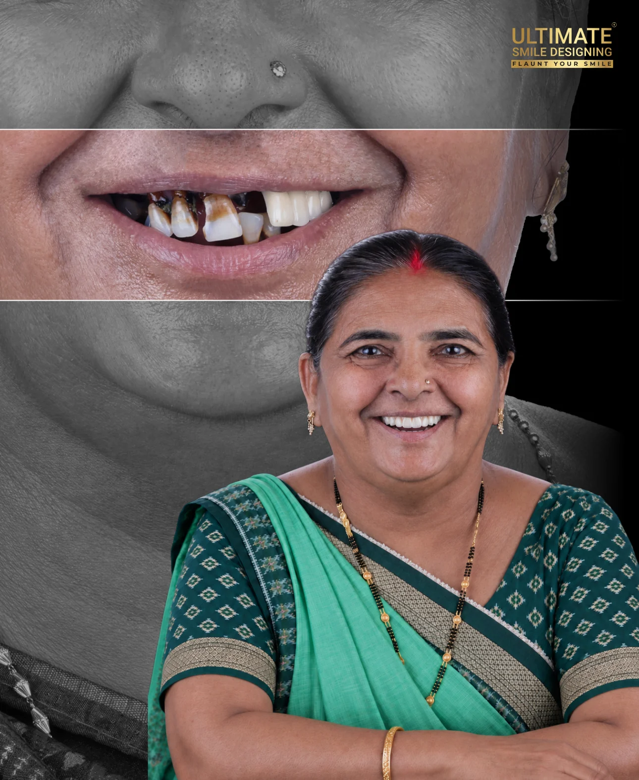 Real patient smile makeover before and after preview created by Ultimate Smile Design