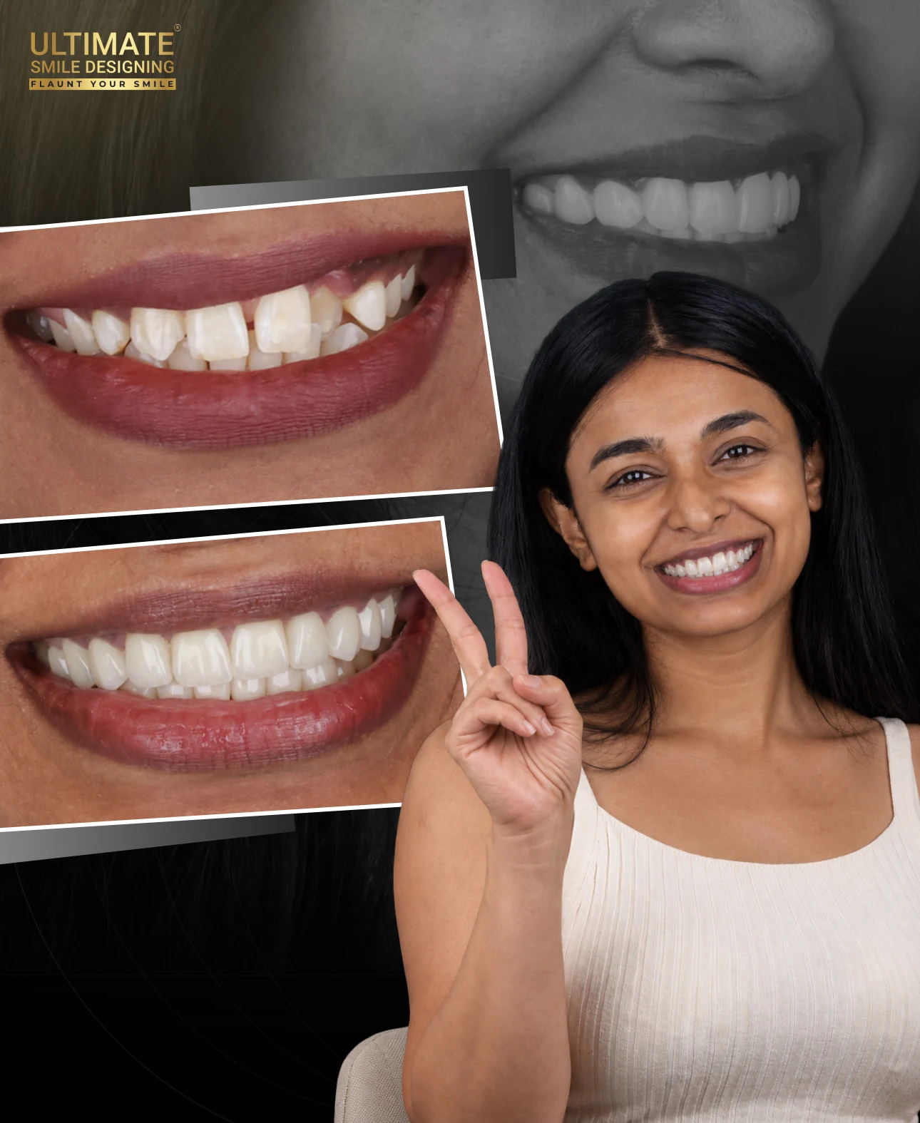 Real patient smile makeover before and after preview created by Ultimate Smile Design