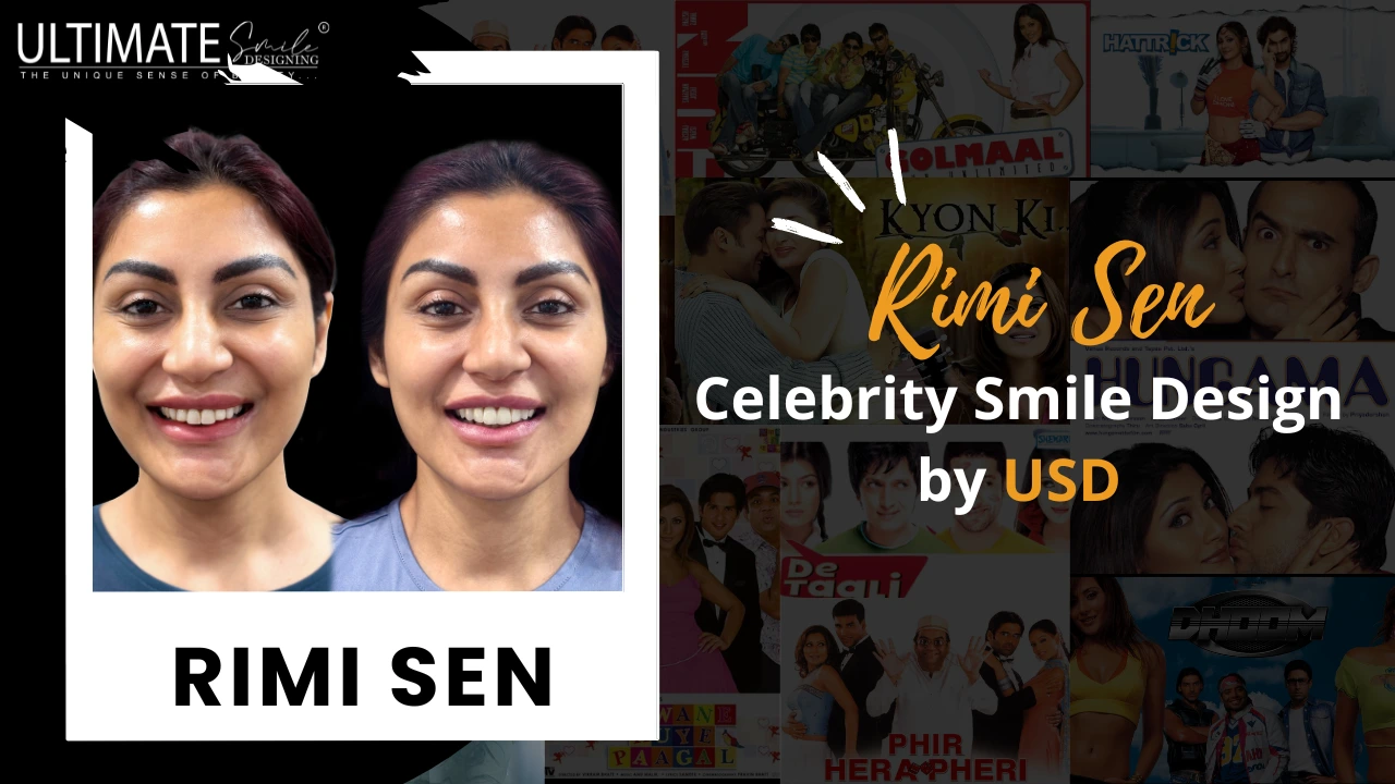 Rimi Sen's Dazzling Smile: Celebrity Smile Design by USD