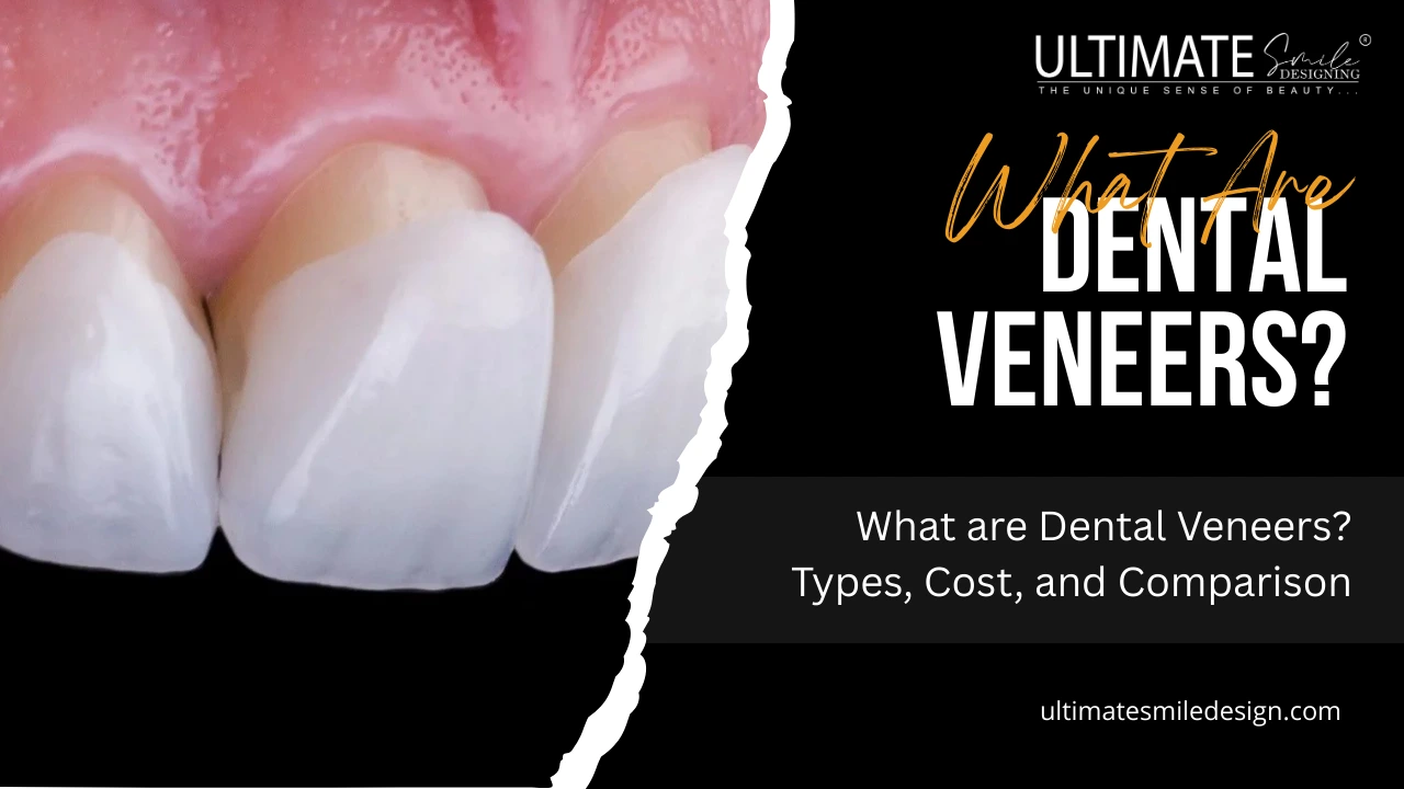 What are Dental Veneers? Types, Cost, and Comparison