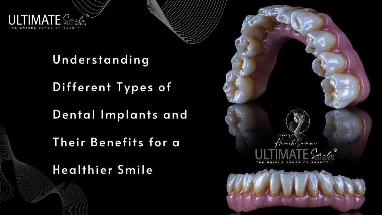 Types of Dental Implants and Their Benefits for Smiles