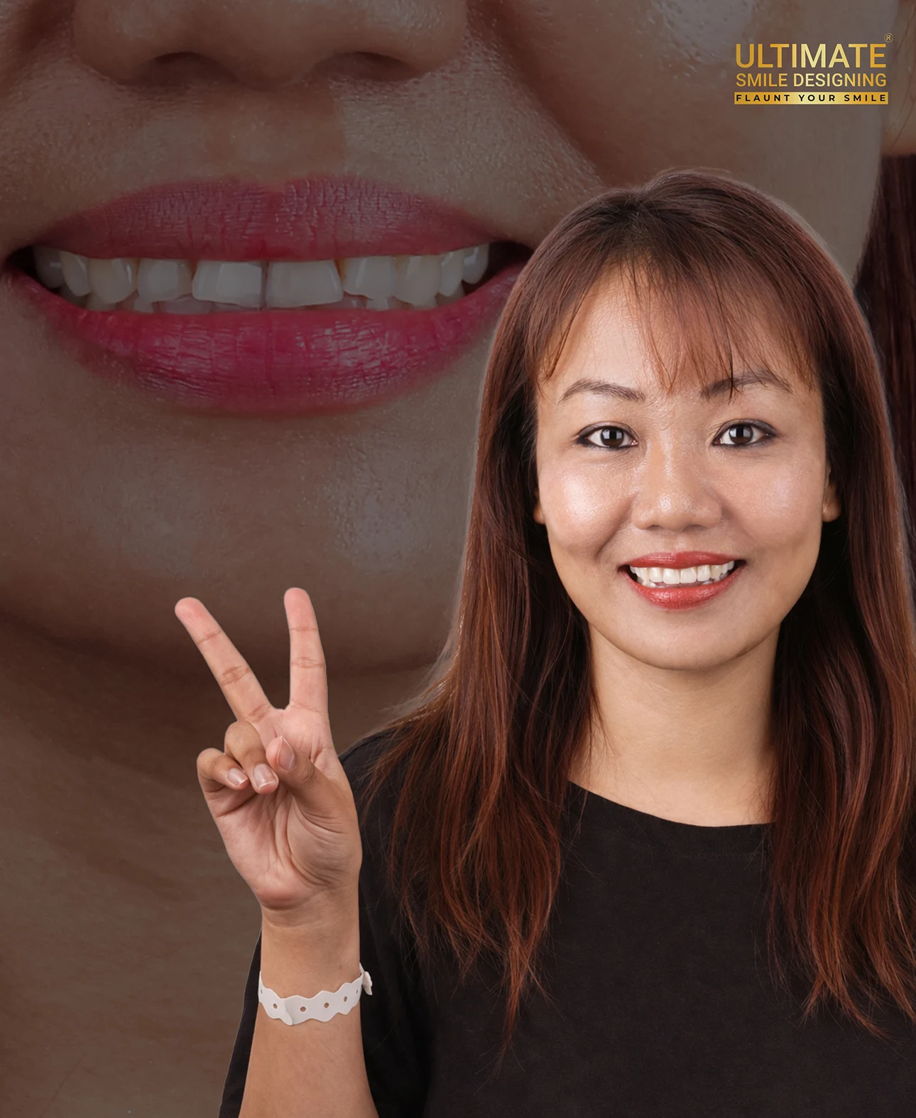 Ultimate Smile Design Service Final Result Image of Dental Prosthesis
