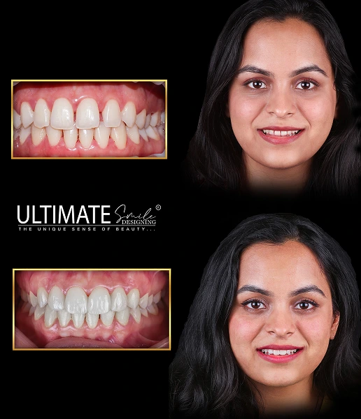 Ultimate Smile Design Service Final Result Image of Dental Prosthesis