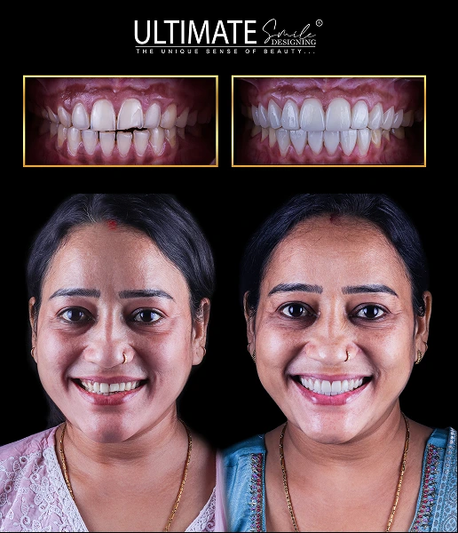 Authentic smile evolution captured in patient showcase at Ultimate Smile Design
