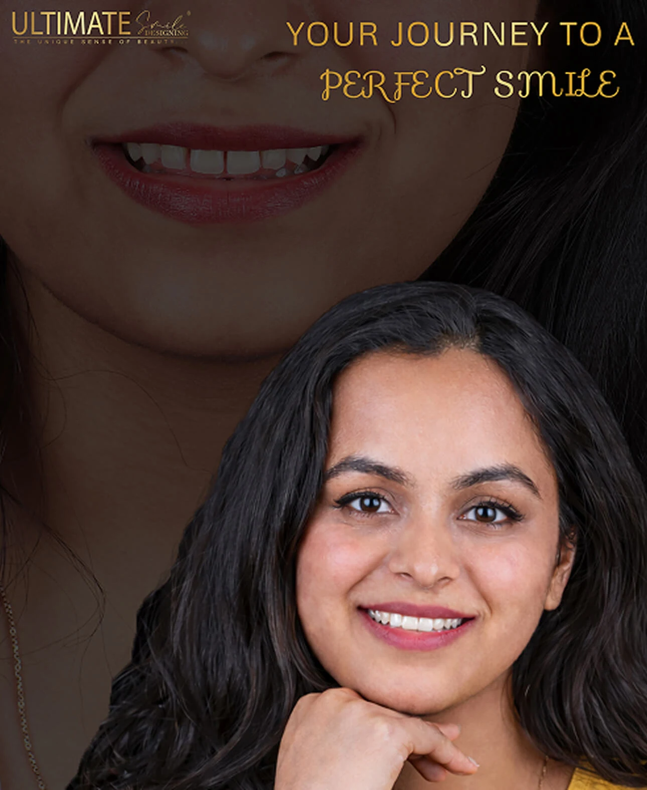 Ultimate Smile Design Service Final Result Image of Dental Prosthesis