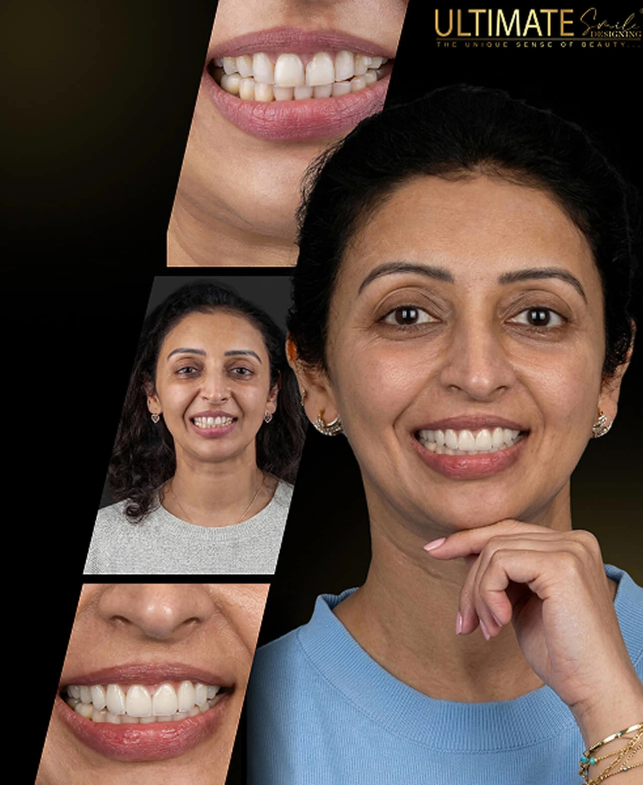 Gallery of restored smiles featuring aesthetic upgrades at Ultimate Smile Design center
