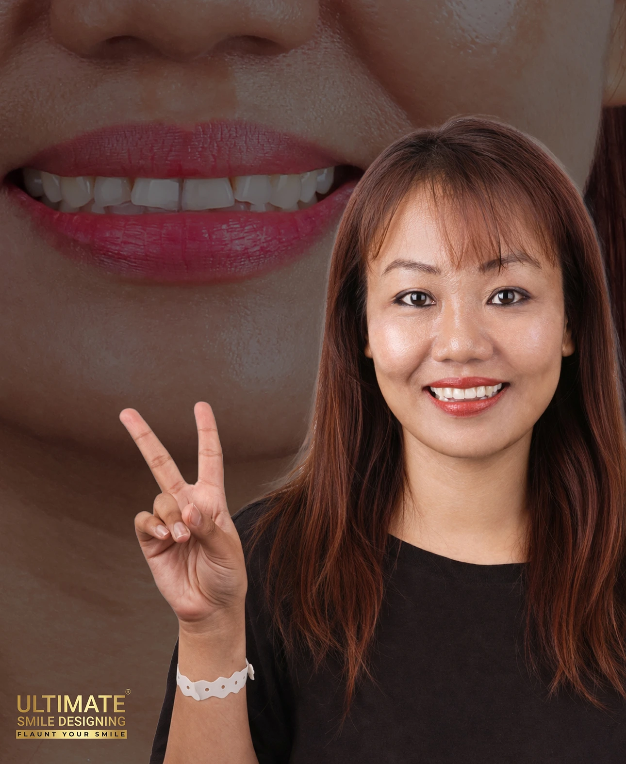 Ultimate Smile Design Service Final Result Image of Dental Prosthesis