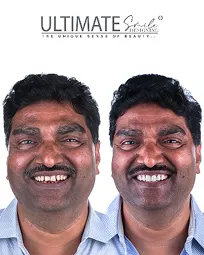 Real transformation gallery from customized dental treatment at Ultimate Smile Design studio