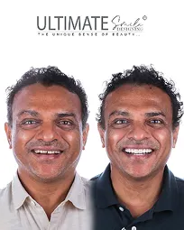 Smile makeover before-after display featuring real patient results at Ultimate Smile Design