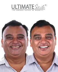 Gallery of restored smiles featuring aesthetic upgrades at Ultimate Smile Design center