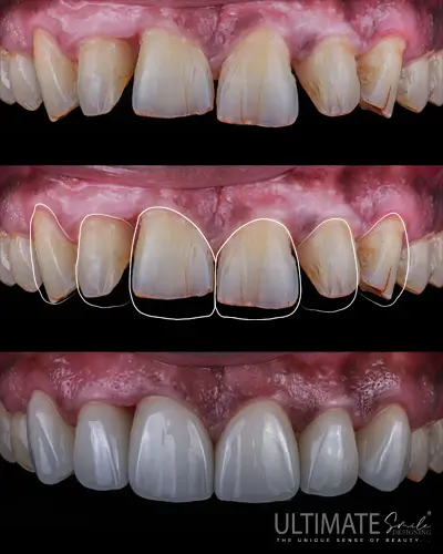 Digital assessment and personalized smile analysis during Ultimate Smile Design procedure