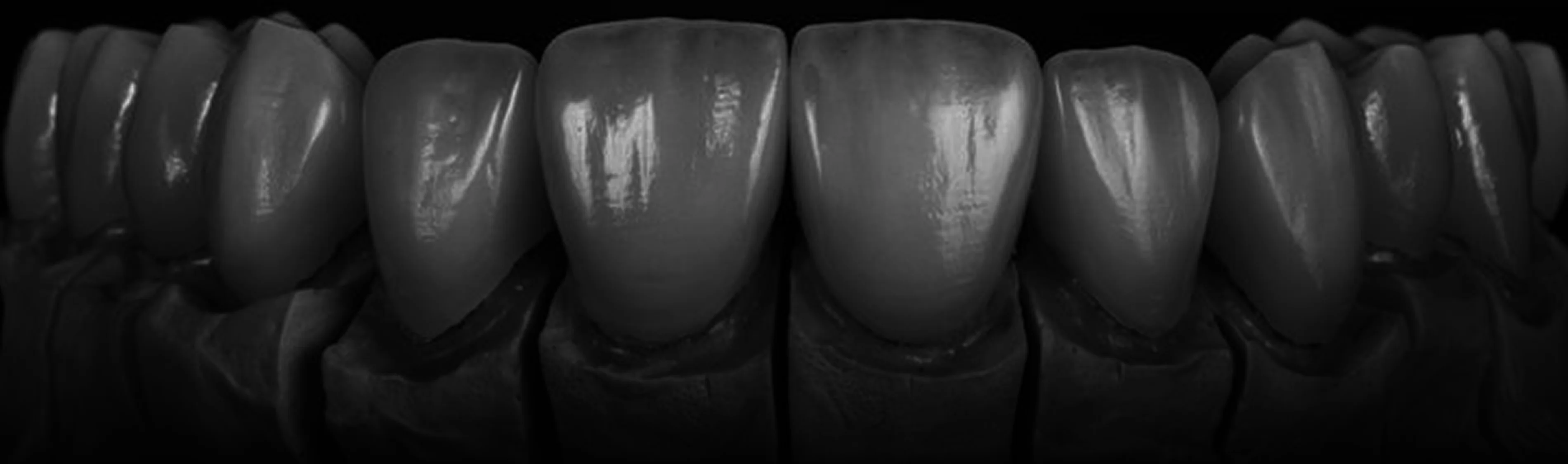 Ultimate Smile Design Image of a Full Arch Teeth in Dark Shade
